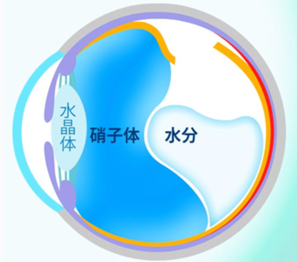 裂孔原性網膜剥離